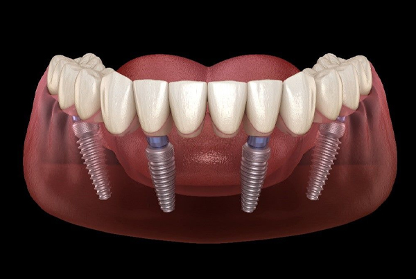 Dental Implants