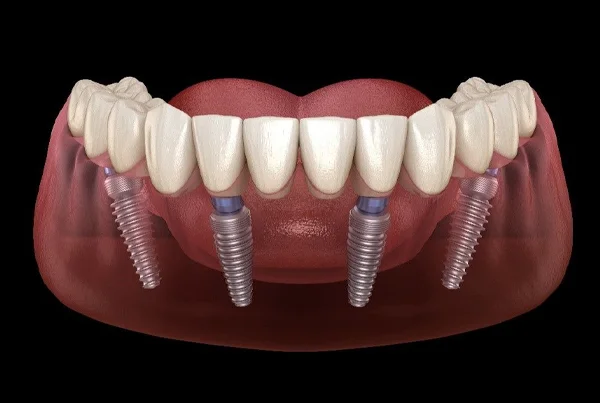 Dental Implants