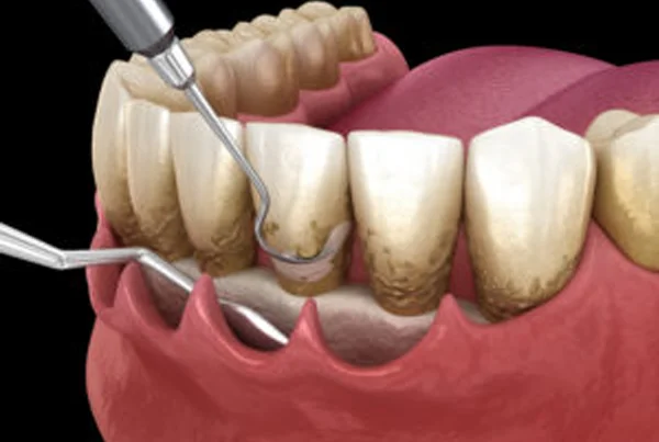 Periodontal (Treatment of Gum Disease)