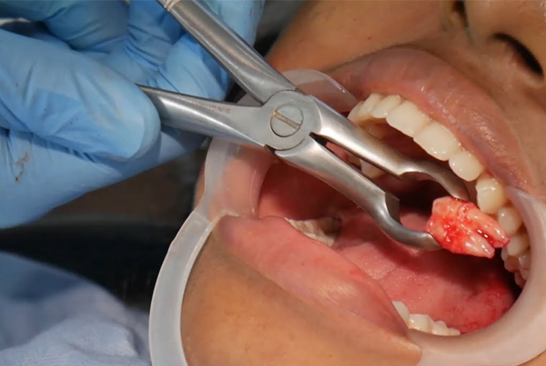 Oral and Maxillofacial Surgery (Facial Surgeries and Surgical Removal of Wisdom tooth)