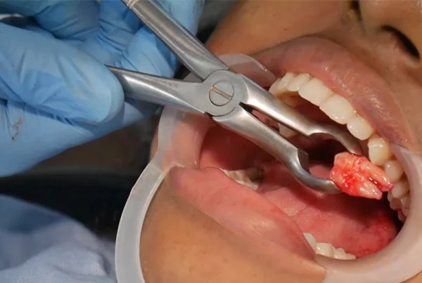 Oral and Maxillofacial Surgery (Facial Surgeries and Surgical Removal of Wisdom tooth)