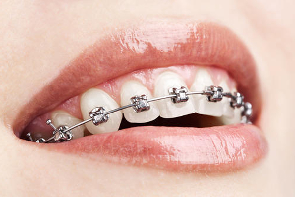 Orthodontic Treatment (Braces)