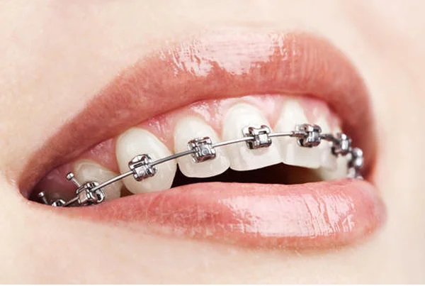Orthodontic Treatment (Braces)