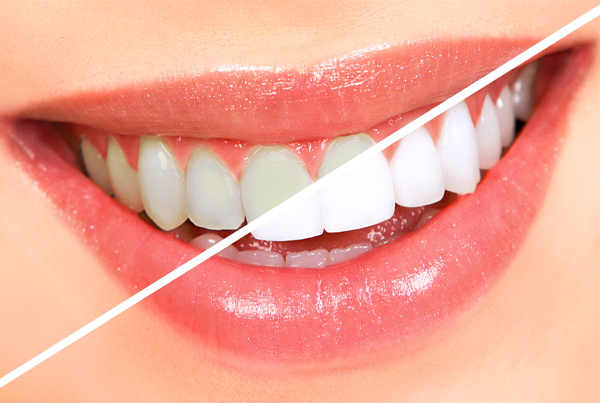 Teeth Whitening (Bleaching)