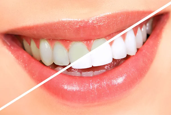 Teeth Whitening (Bleaching)