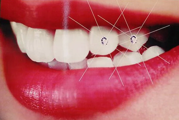 Dental Jewellery
