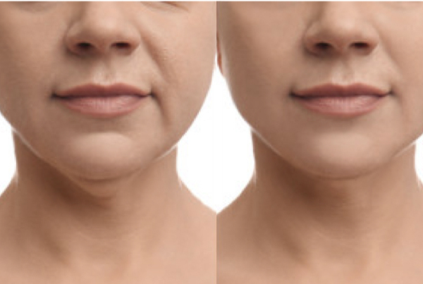 Nefertiti Lift (Neck)