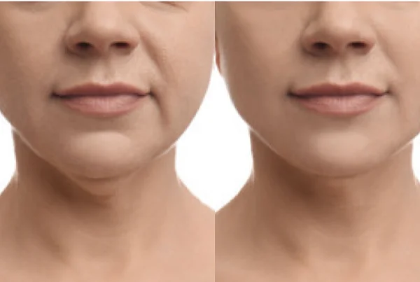 Nefertiti Lift (Neck)