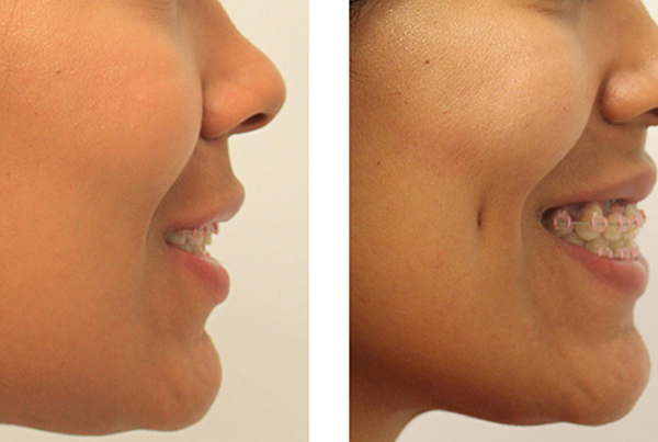 Dimple Creation