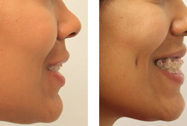 Dimple Creation